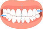 Crossbite