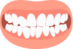 Crowded Teeth
