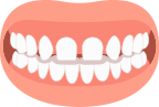 Gapped Teeth