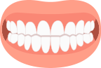 Underbite