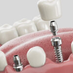 dental implants types