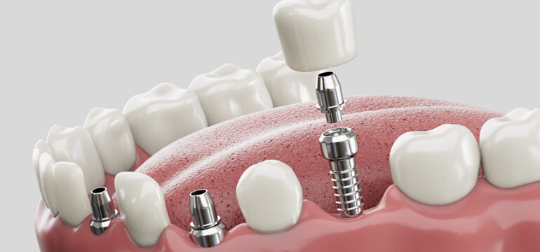 dental implants types