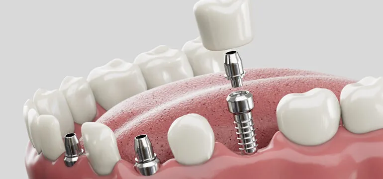 dental implants types