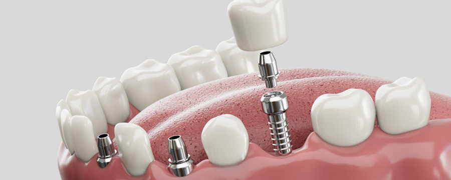 dental implants types