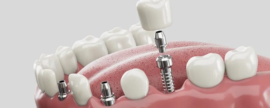 dental implants types