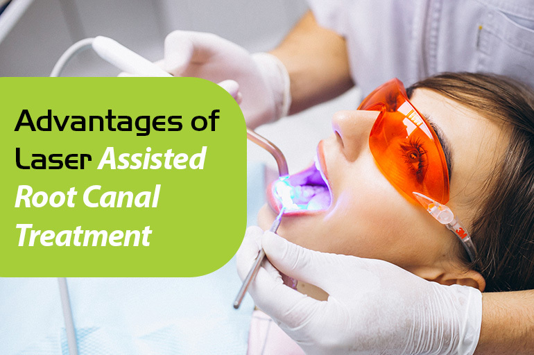 the laser assisted root canal treatment