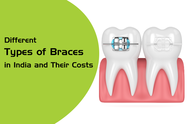 different types of braces in india and their cost