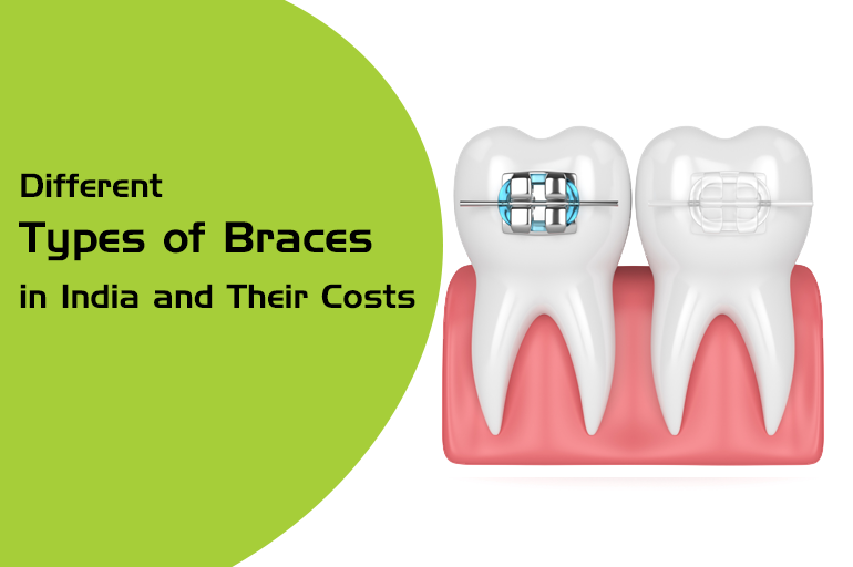 different types of braces in india and their cost