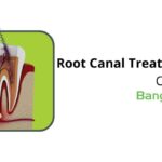 root canal cost in bangalore price guide