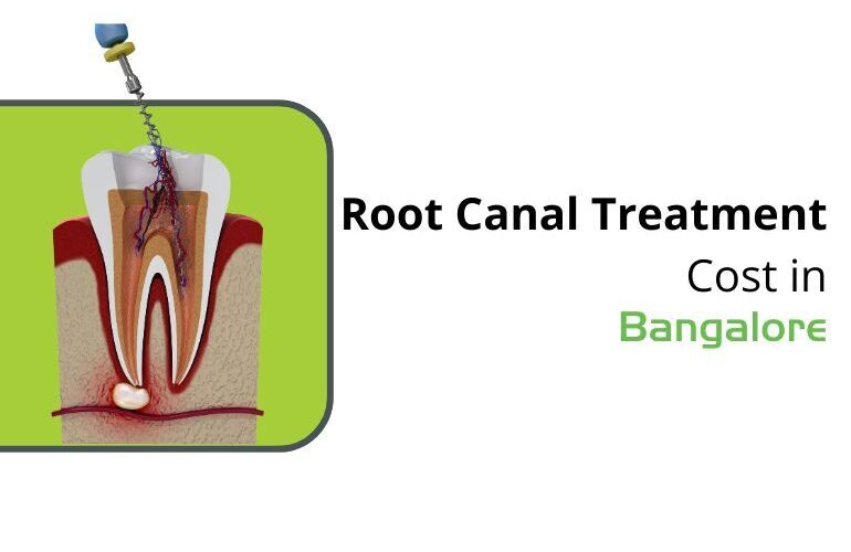 root canal cost in bangalore price guide
