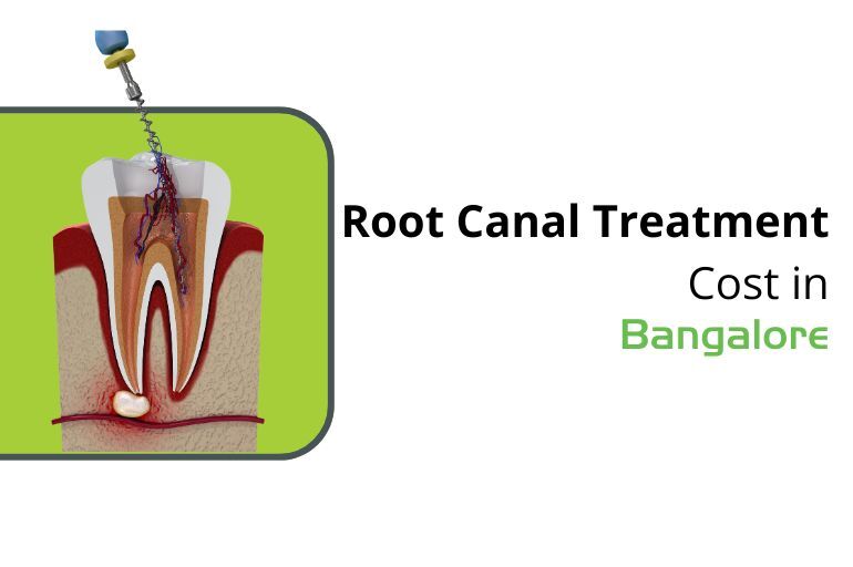 root canal cost in bangalore price guide