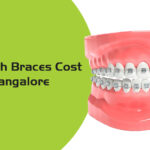 teeth braces cost in bangalore