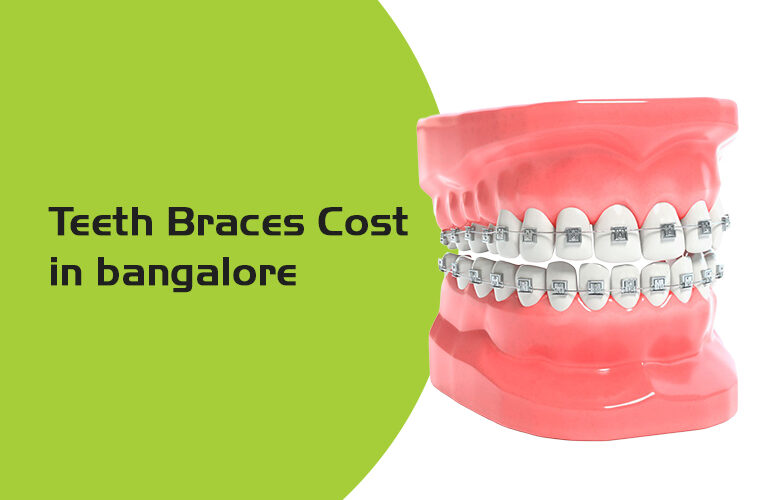 teeth braces cost in bangalore