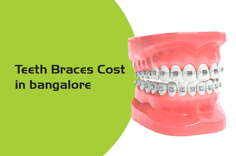 teeth braces cost in bangalore
