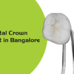 dental crown cost in bangalore