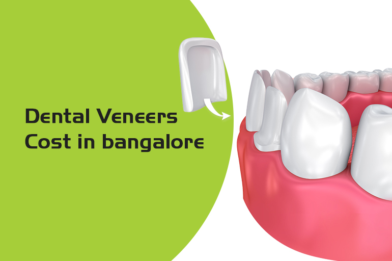 dental veneers cost in bangalore