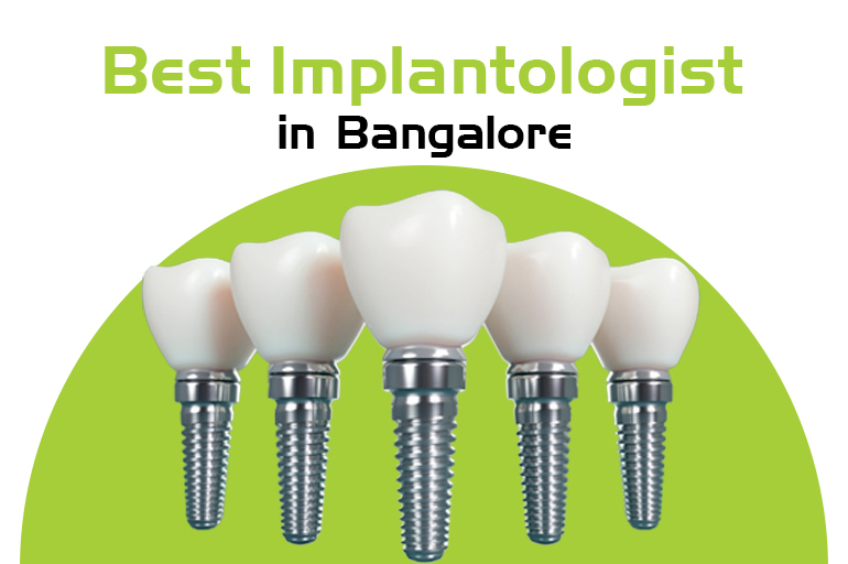 best implantologist in bangalore