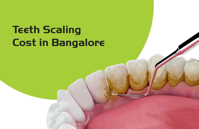 teeth scaling cost in Bangalore