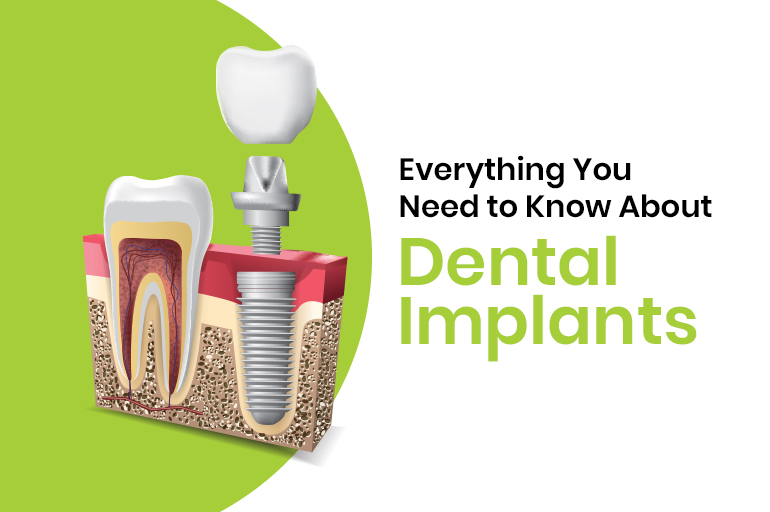 credence-dental-implant