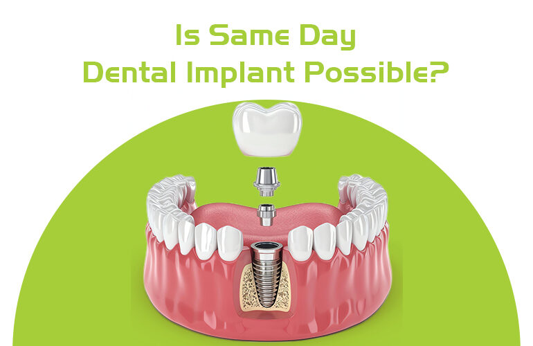 is same day dental implant possible