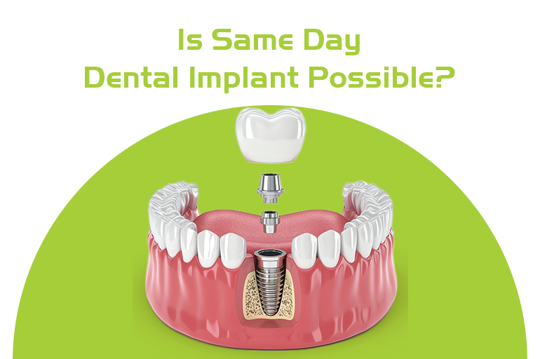 is same day dental implant possible
