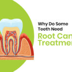 root canal treatment in bangalore