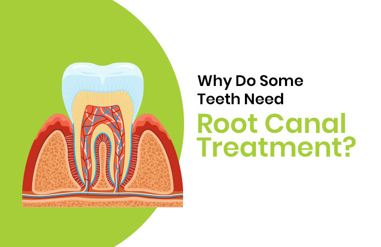 root canal treatment in bangalore