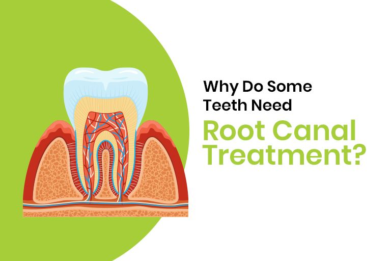 root canal treatment in bangalore