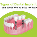 types of dental implants