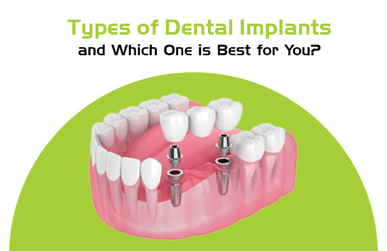 types of dental implants