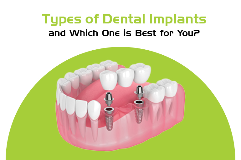 types of dental implants
