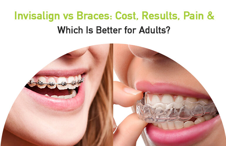 invisalign vs braces