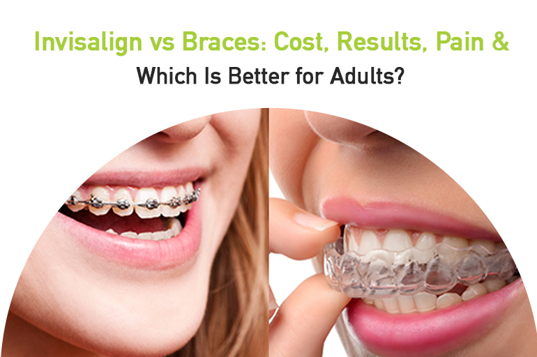 invisalign vs braces