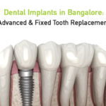 dental implants in bangalore- advanced & fixed tooth replacement