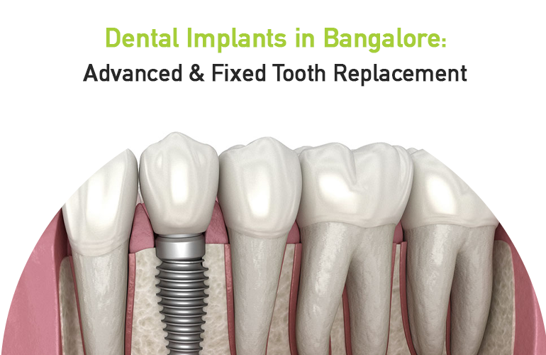dental implants in bangalore- advanced & fixed tooth replacement