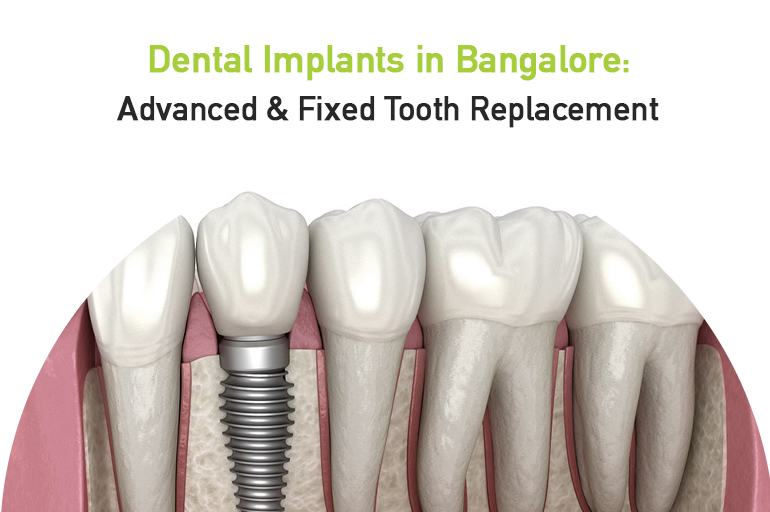 dental implants in bangalore- advanced & fixed tooth replacement