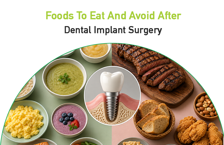 foods to eat and avoid after dental implant surgery