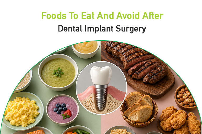 foods to eat and avoid after dental implant surgery