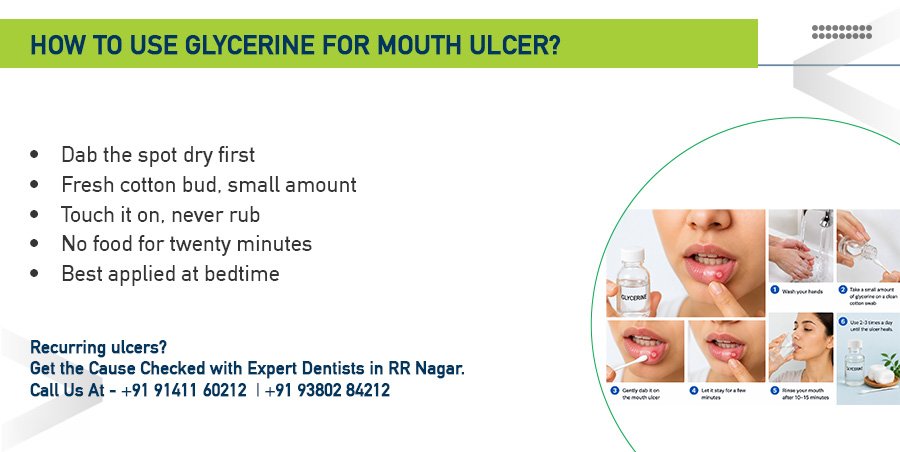 how to use glycerine for mouth ulcer
